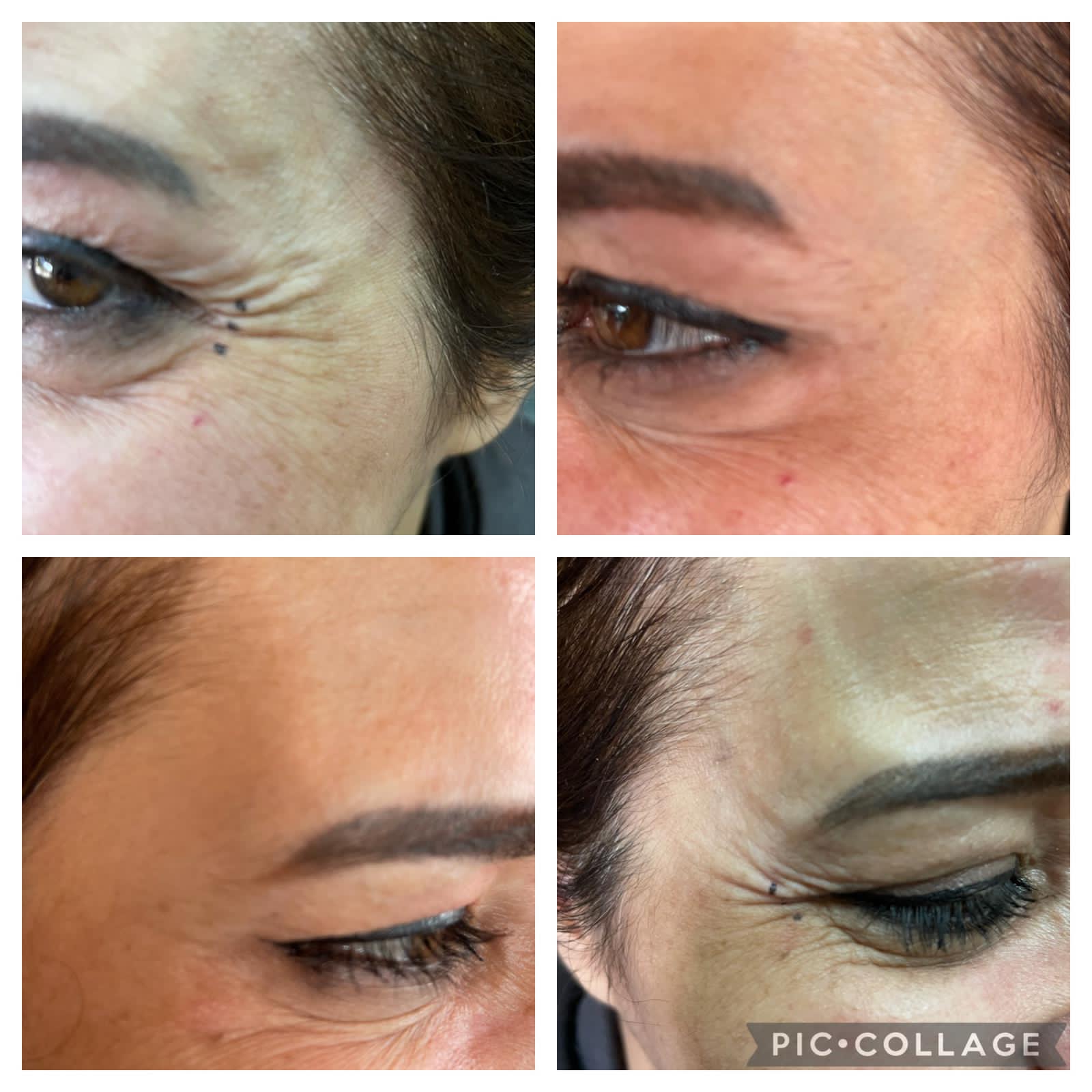 Behandlungsergebnis im Augen- und Stirnbereich